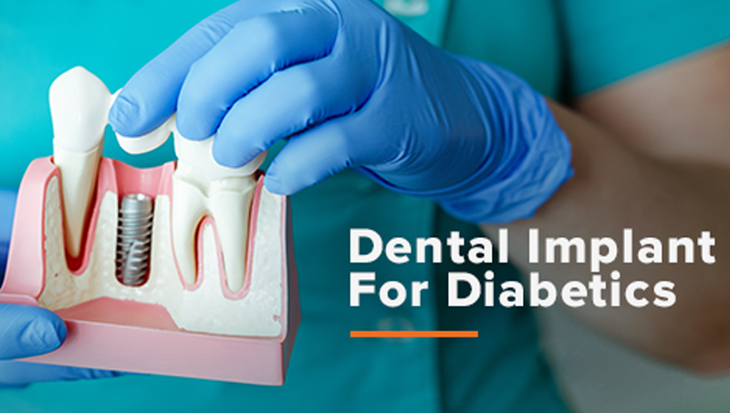 Are Dental Implants Safe For You If You Have Diabetes?